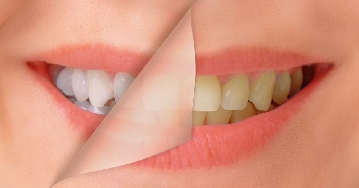 Teeth Whitening in Gurgaon