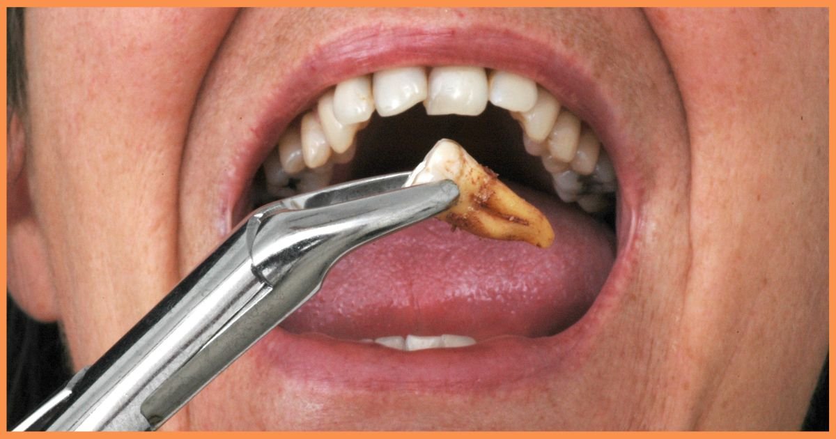 Wisdom Tooth Extraction in Gurgaon