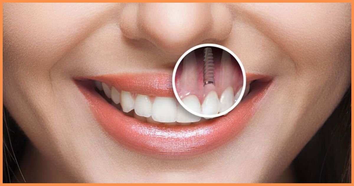 Dental implants in Gurgaon
