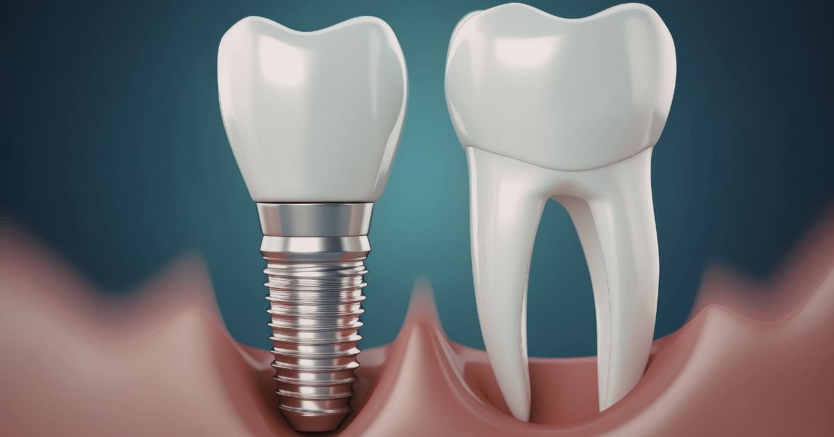 Implantologist in Gurgaon