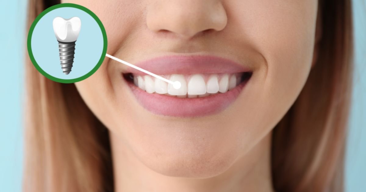 Dental implants in Gurgaon