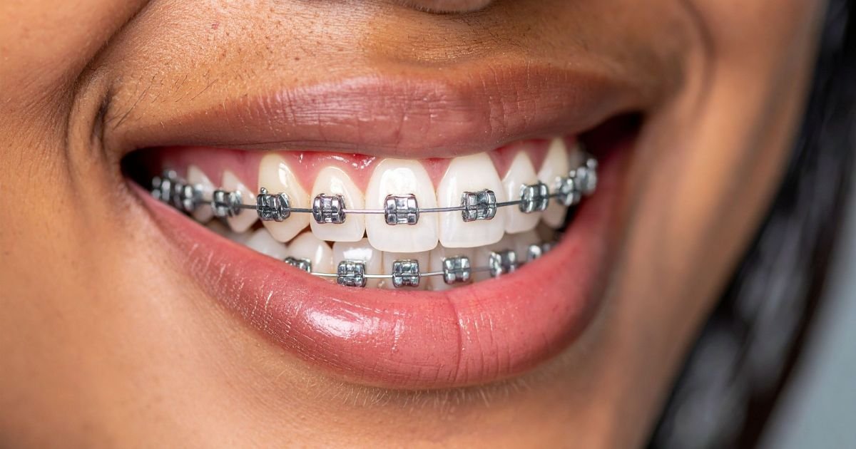 Braces Treatment in Gurgaon