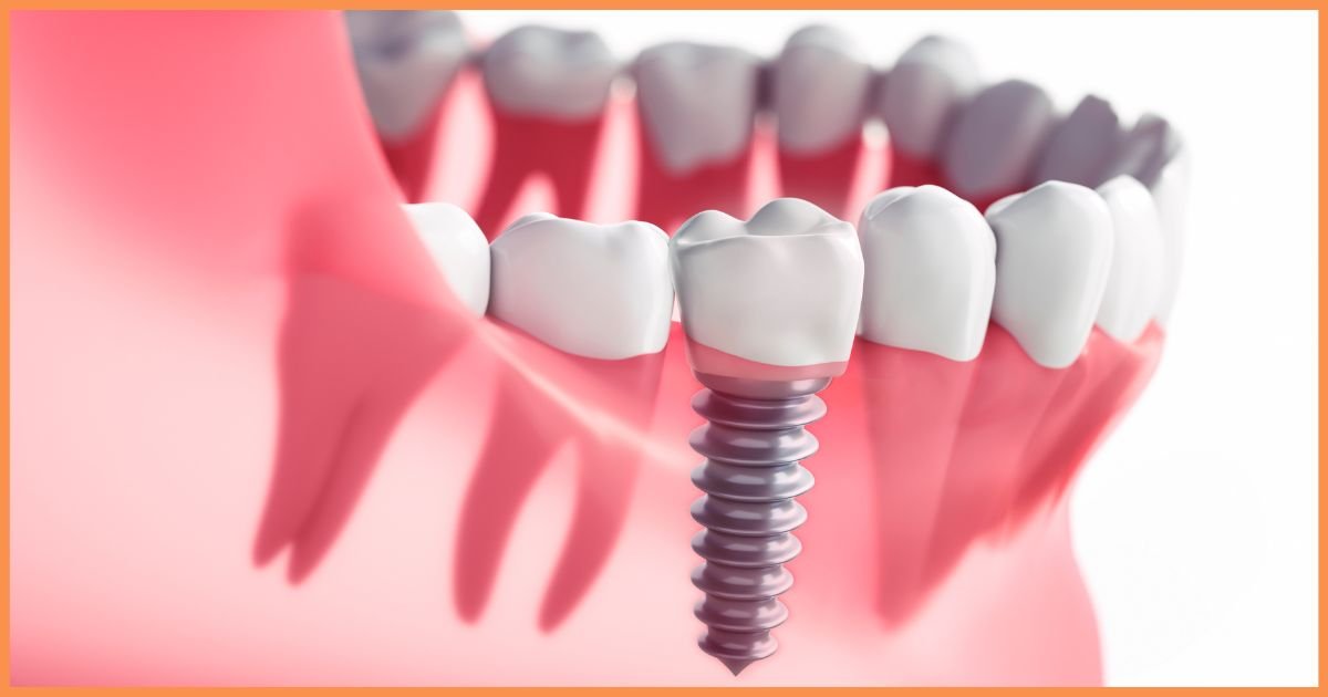Dental implants in Gurgaon