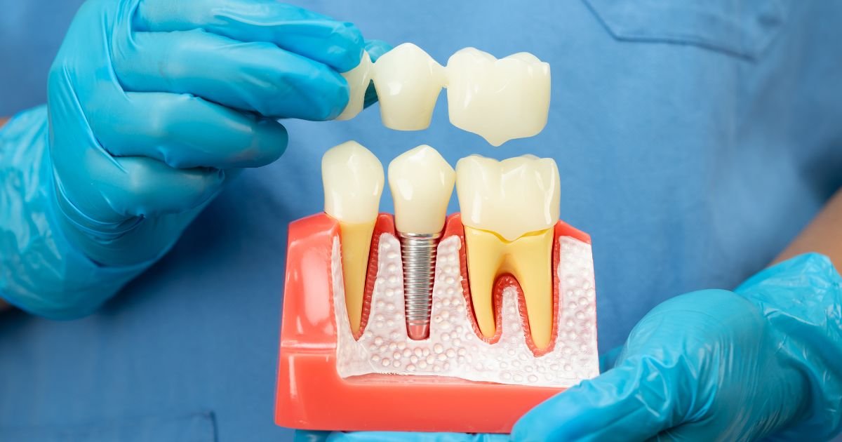 implantologist in Gurgao