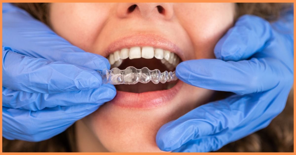 Invisalign in Gurgaon