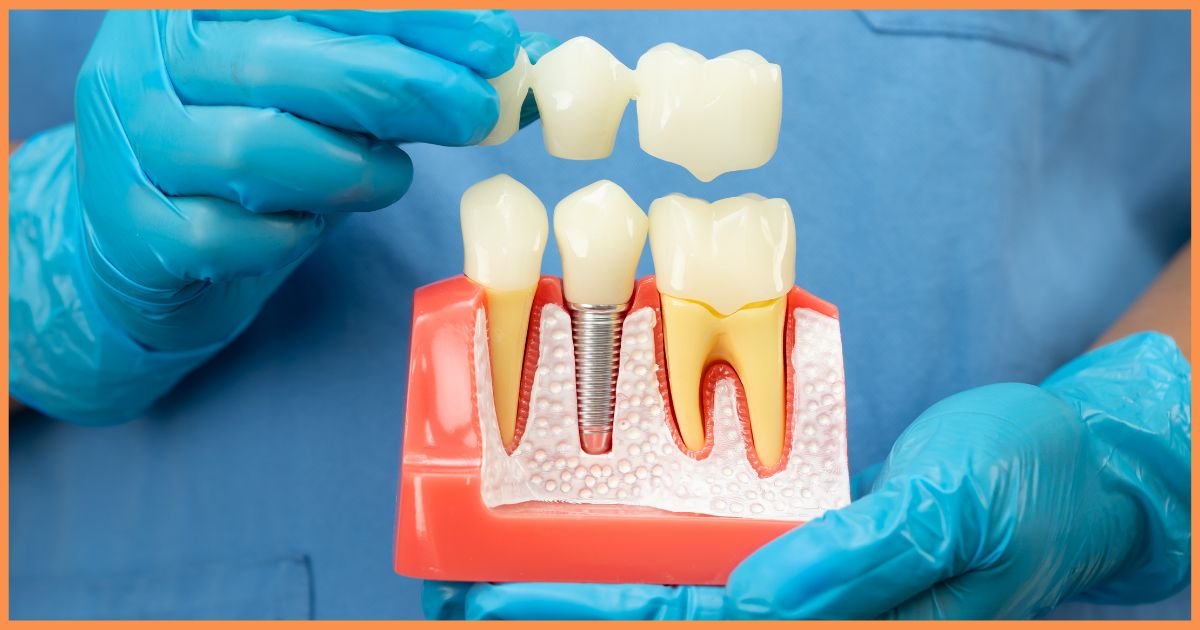 Root Canal Treatment in Gurgaon