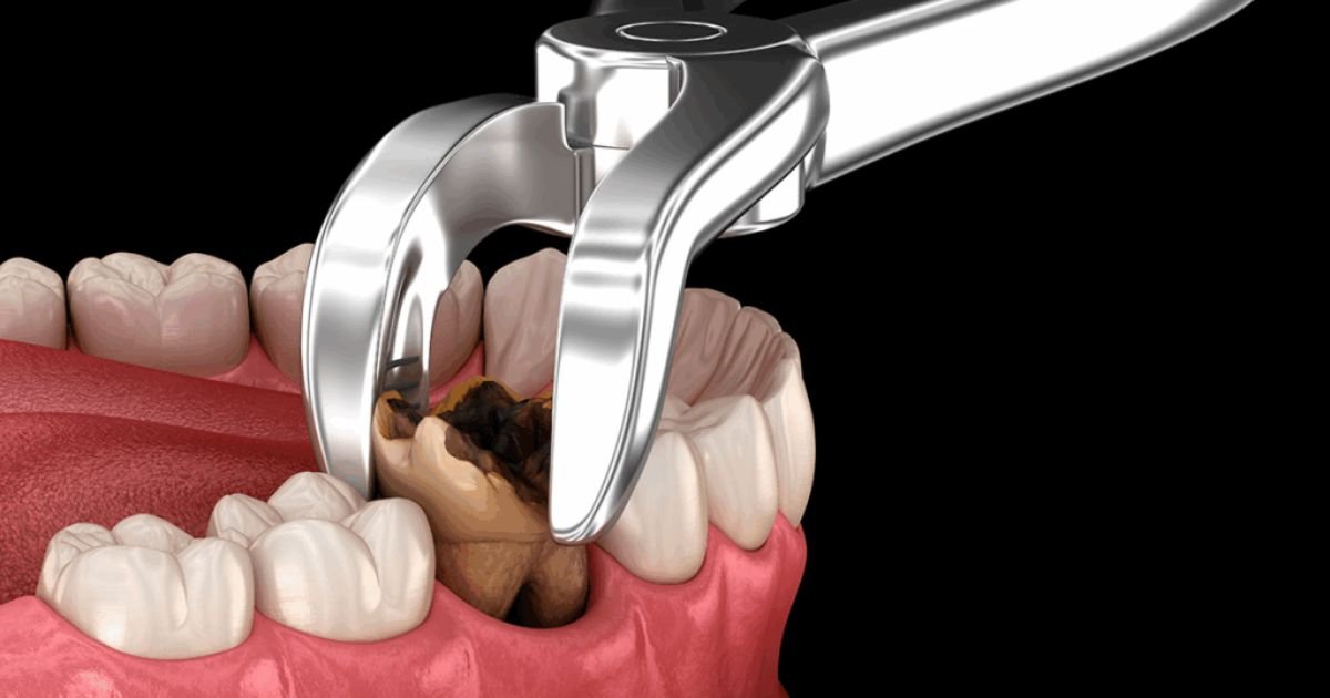 Wisdom Tooth Extraction in Gurgaon