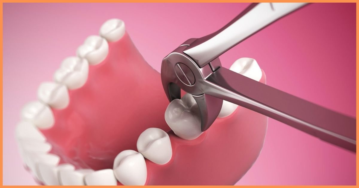 Wisdom Tooth Extraction in Gurgaon