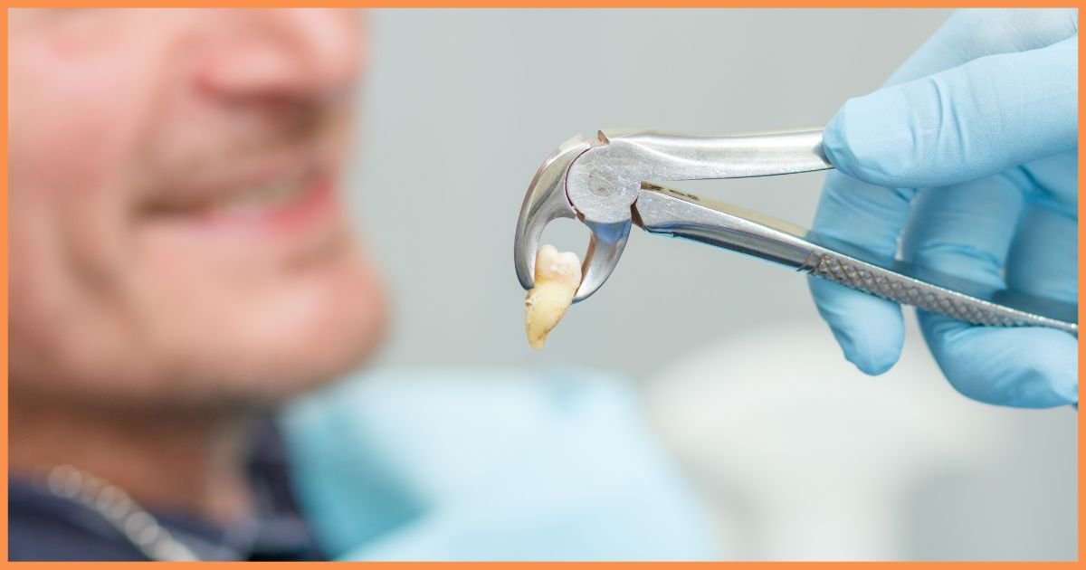 Wisdom Tooth Extraction in Gurgaon