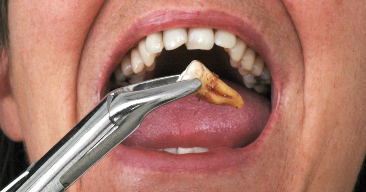 Wisdom Tooth Extraction