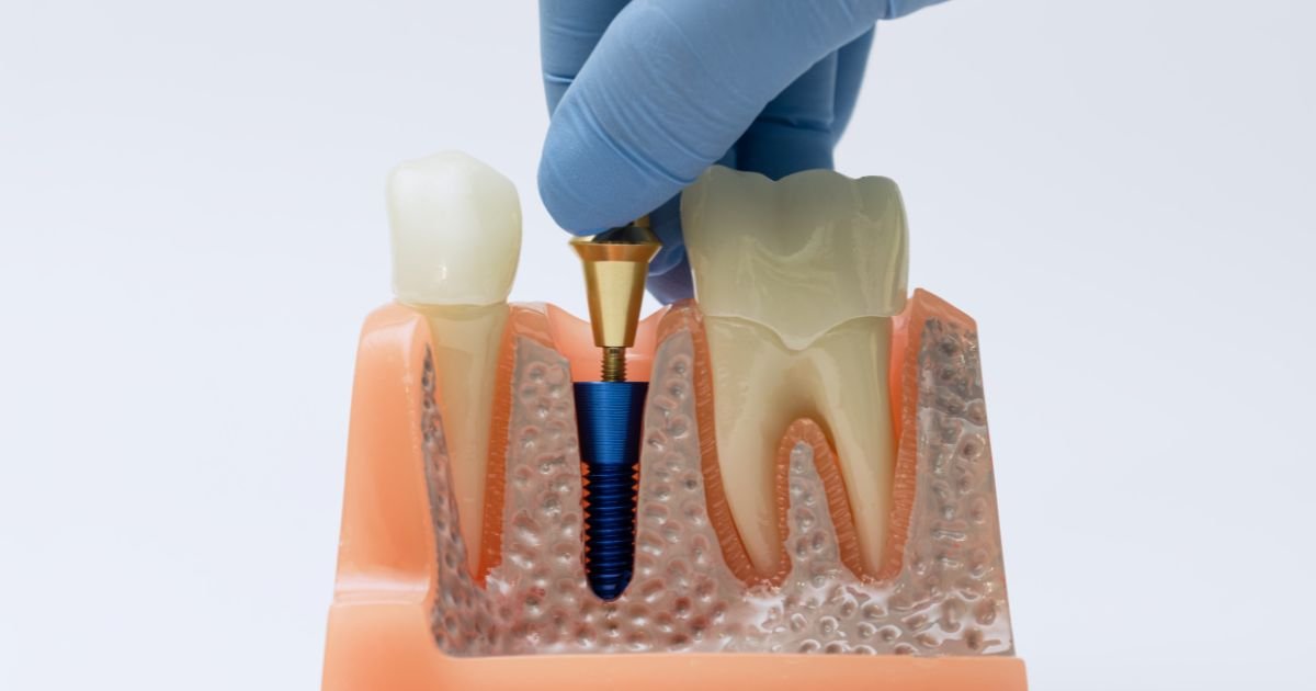 Dental implants in Gurgaon