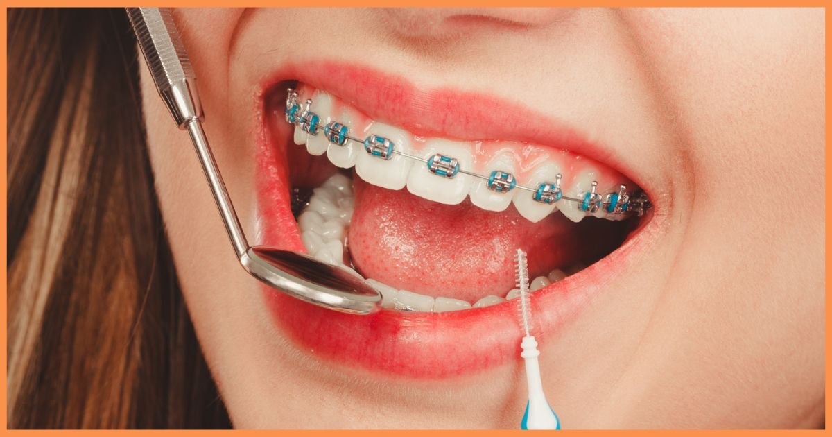 Orthodontic Treatment