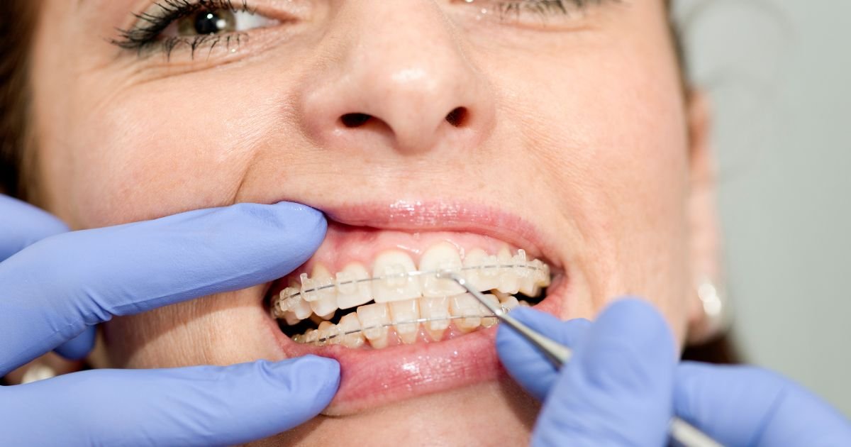 Orthodontic Treatment