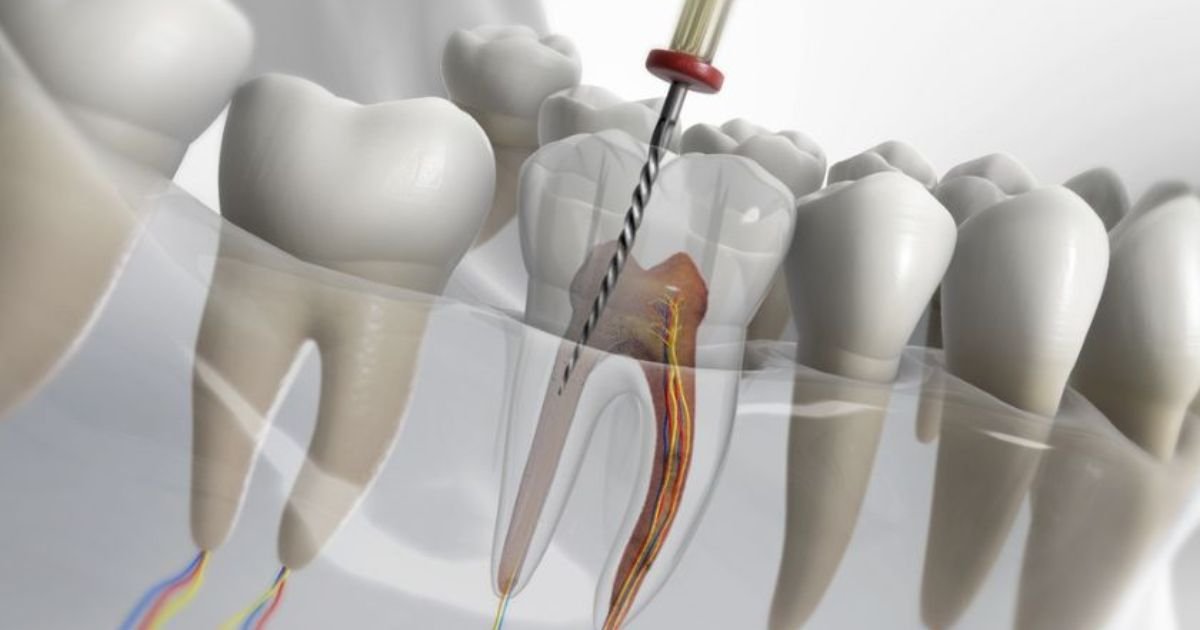 Root Canal Treatment in Gurgaon