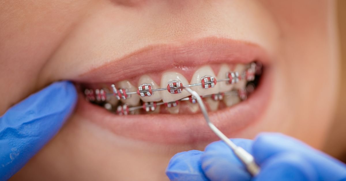 Braces