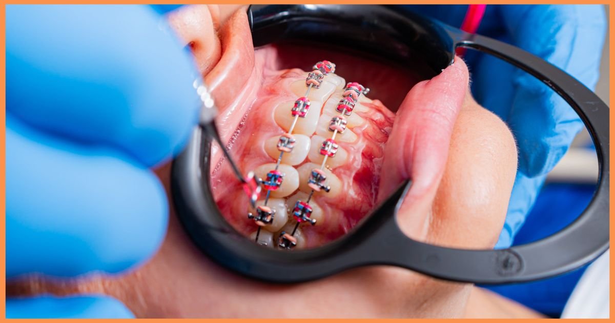 Braces