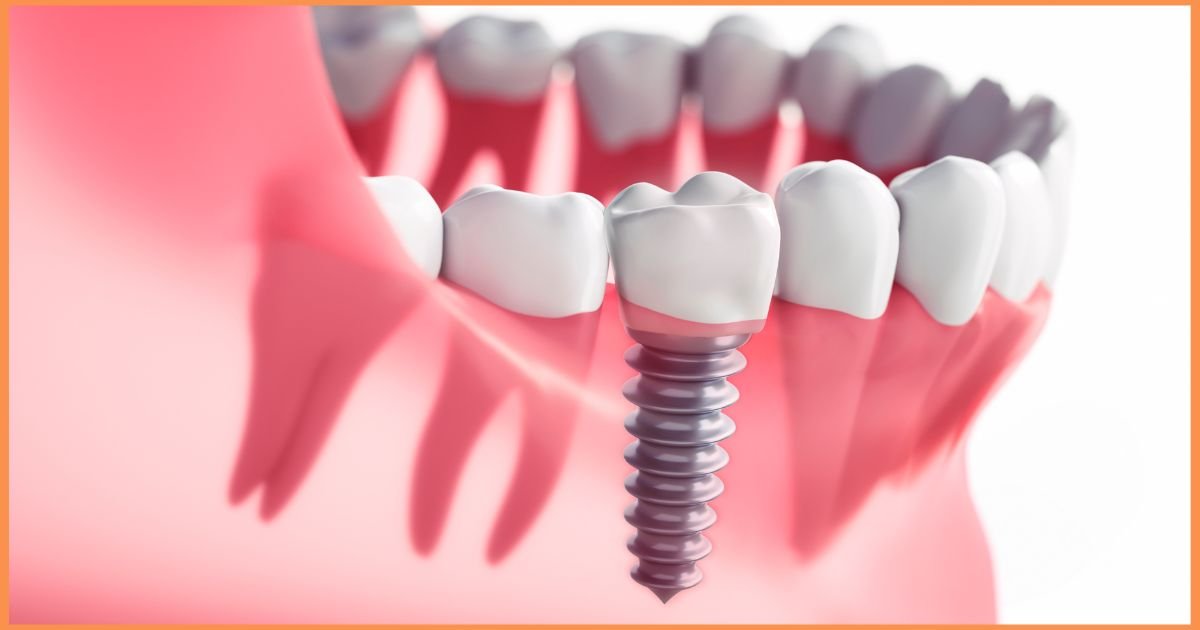 Dental implant