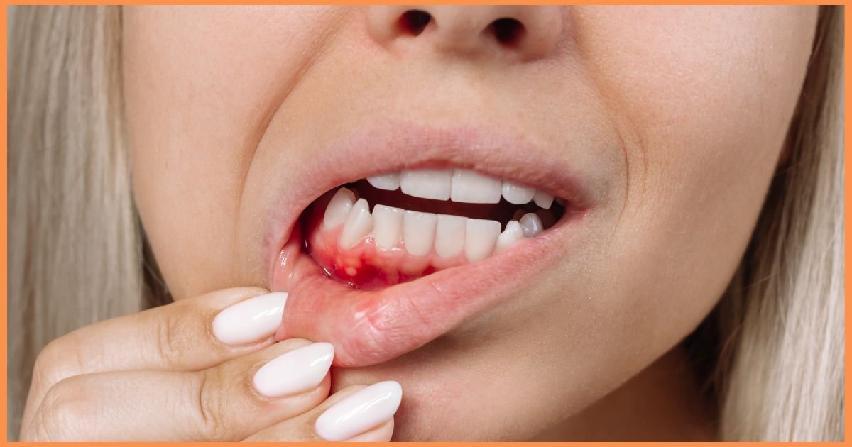 Gum Bleeding