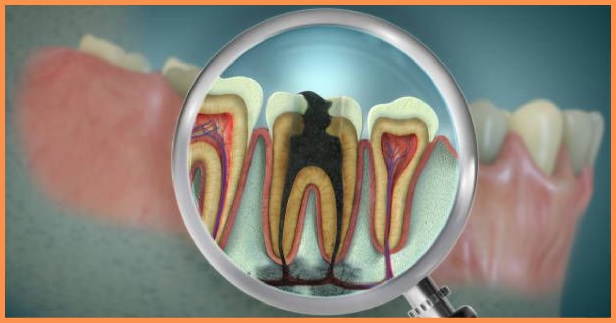 Root Canal Treatment in Gurgaon