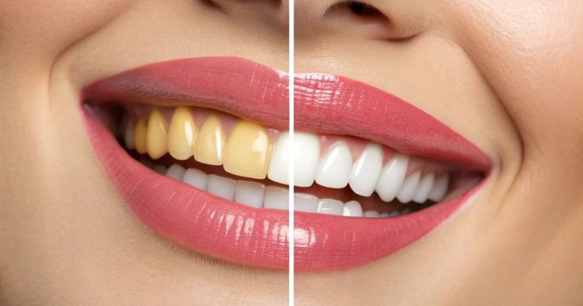 Teeth Whitening