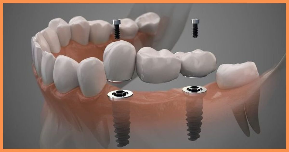Dental Implant