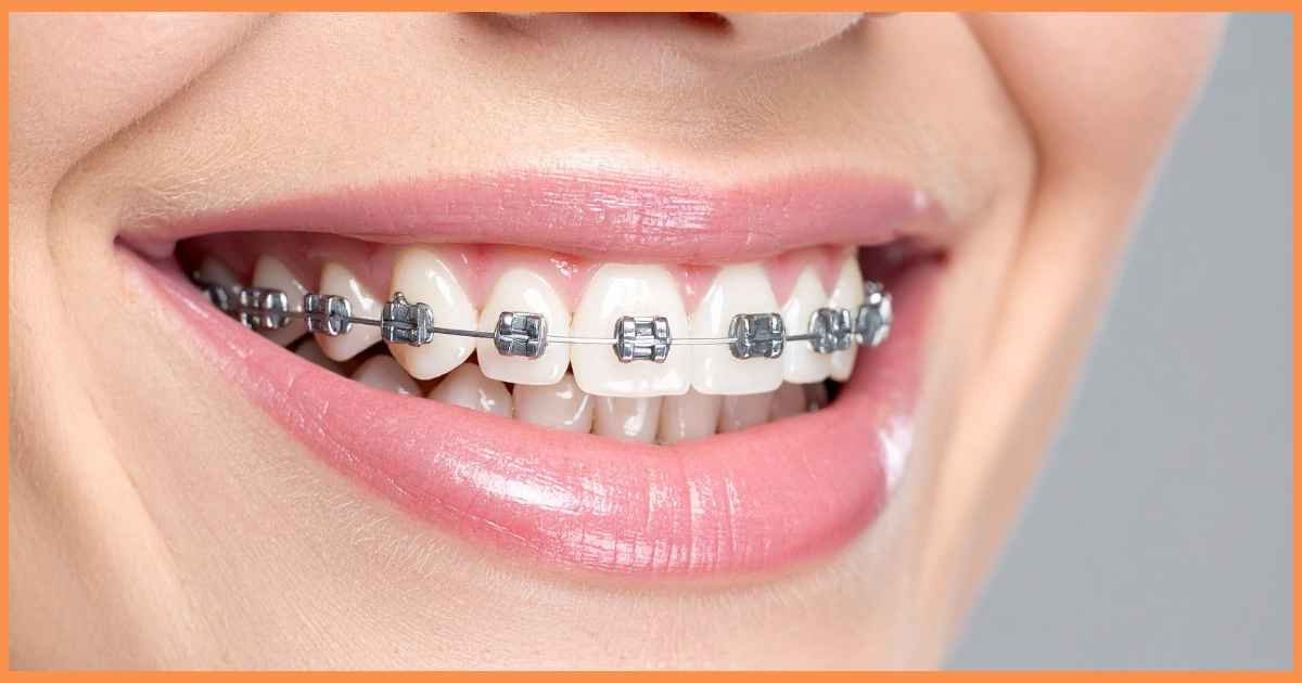 Orthodontic Treatment