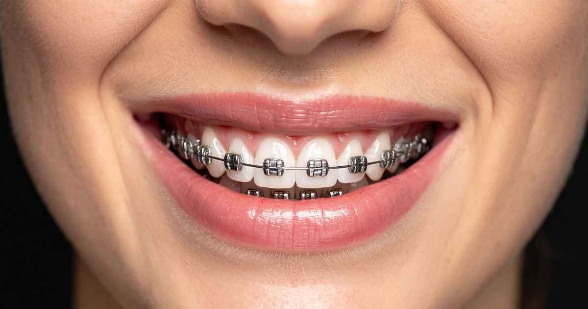Orthodontic Treatment