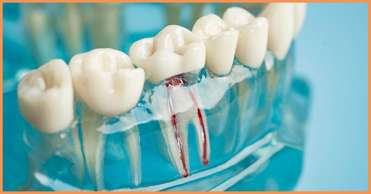 root canal treatment