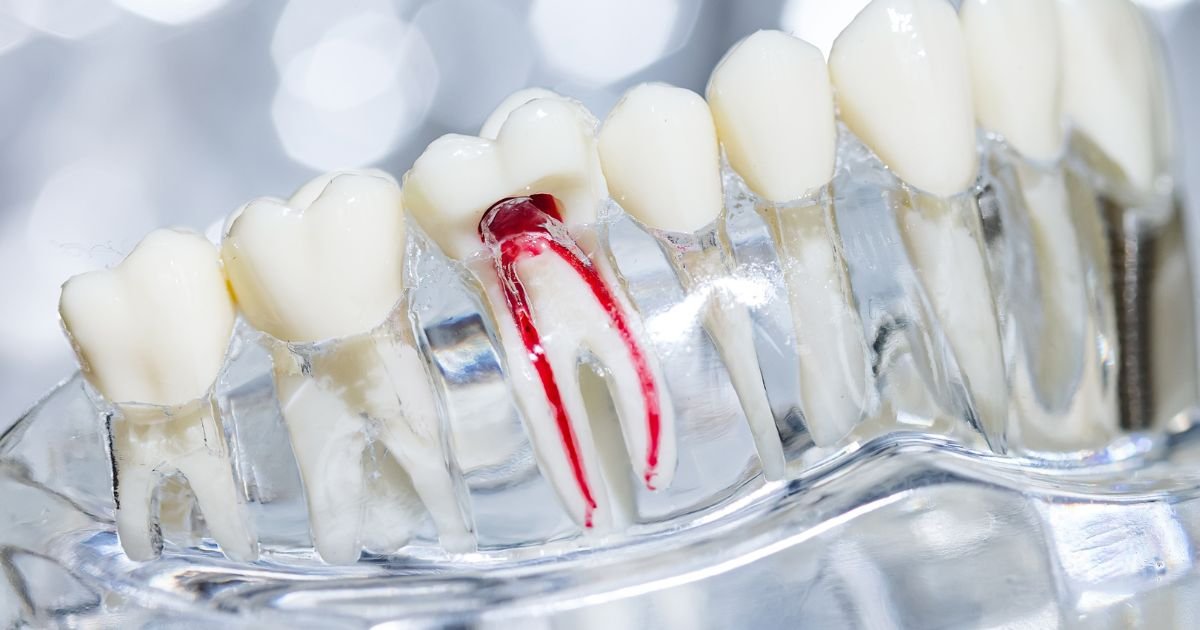 root canal treatment