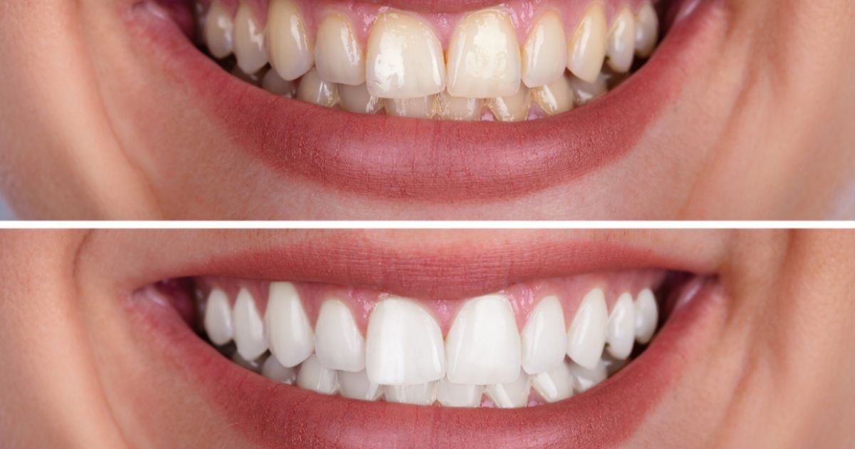 Teeth Whitening