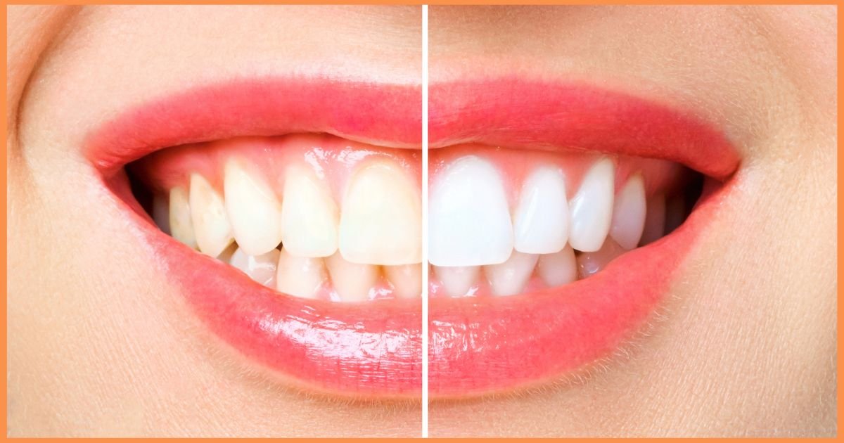 Teeth Whitening