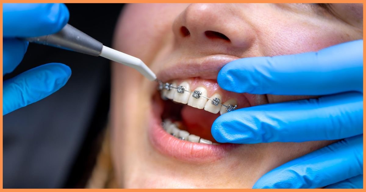 Braces Treatment