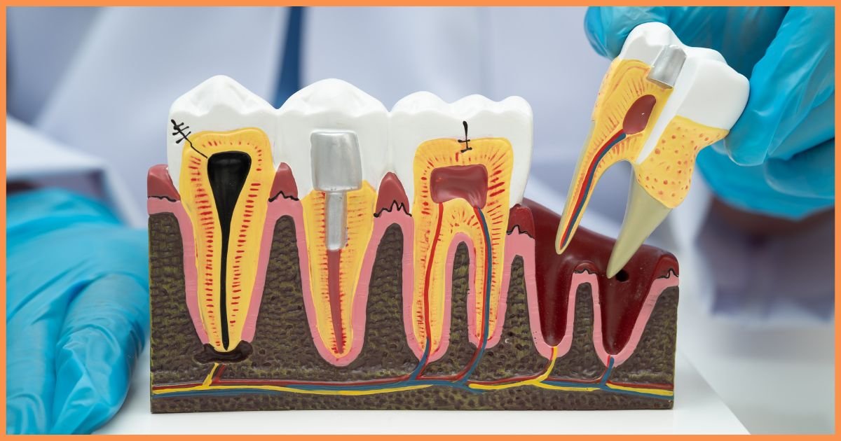 Root Canal Treatment