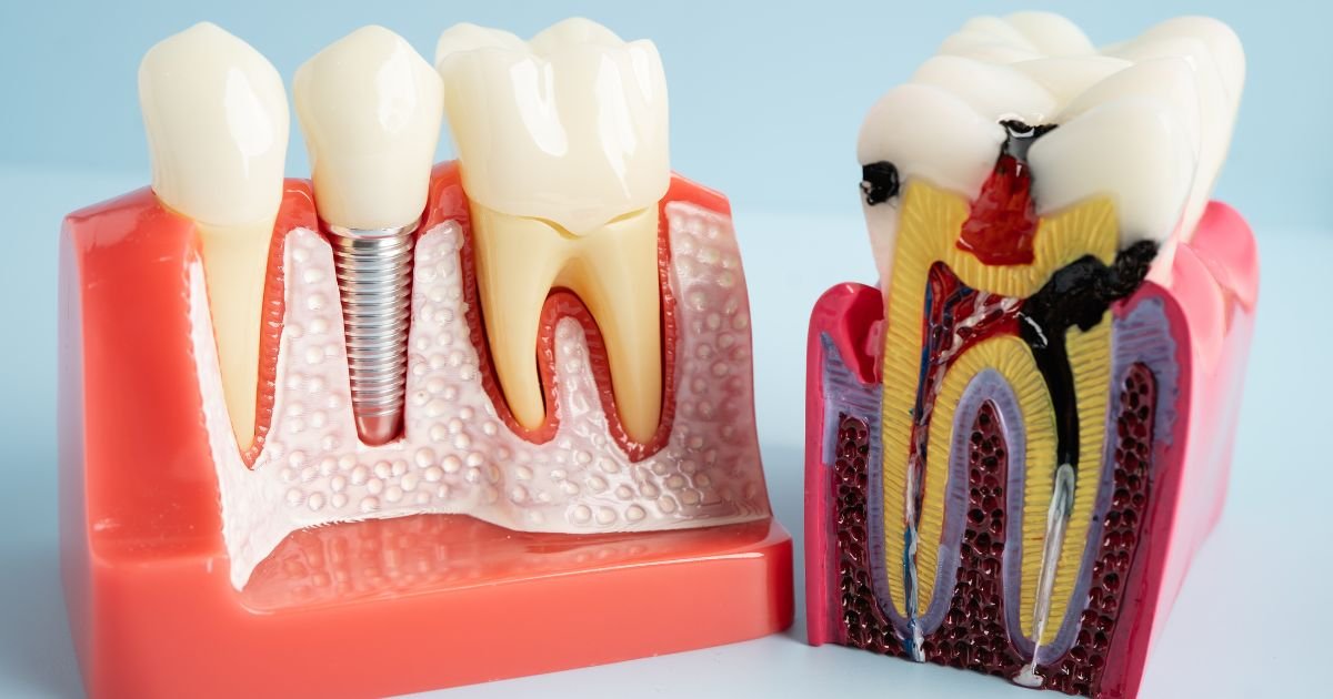 Root Canal Treatment