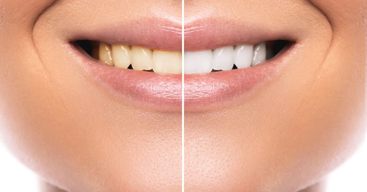 Teeth Whitening