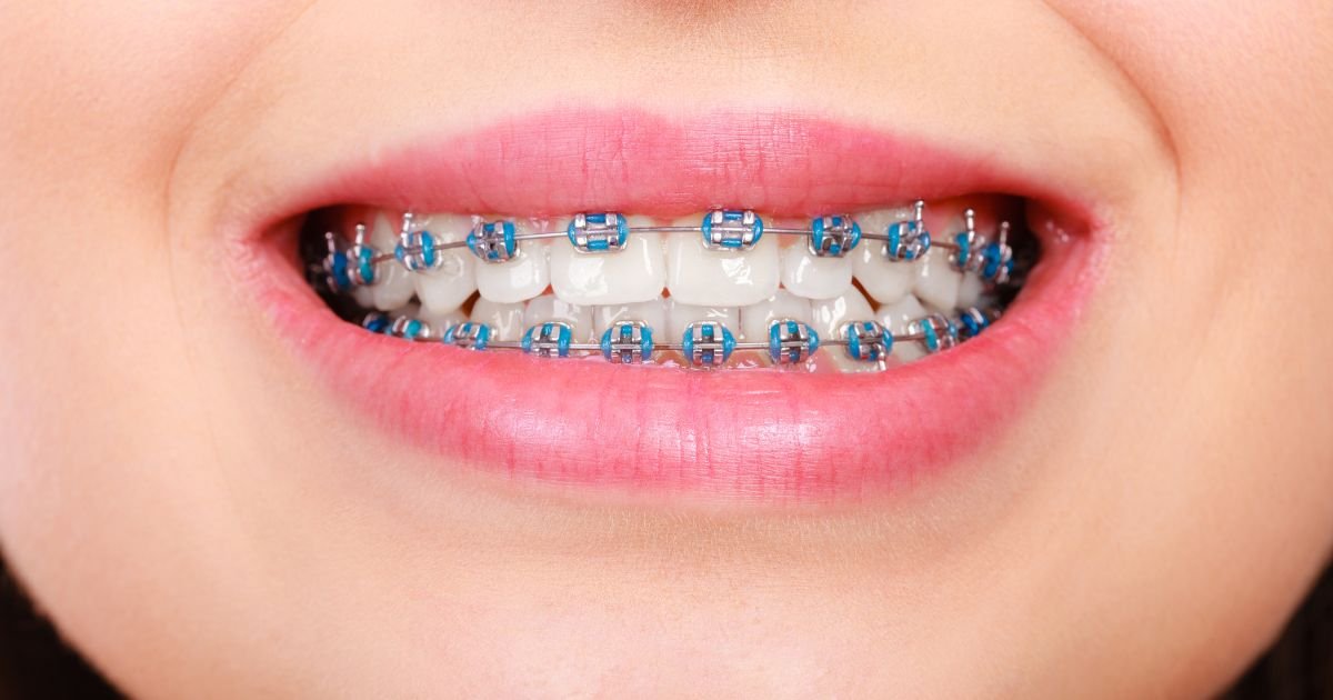 Do Braces Make Teeth 100% Straight?