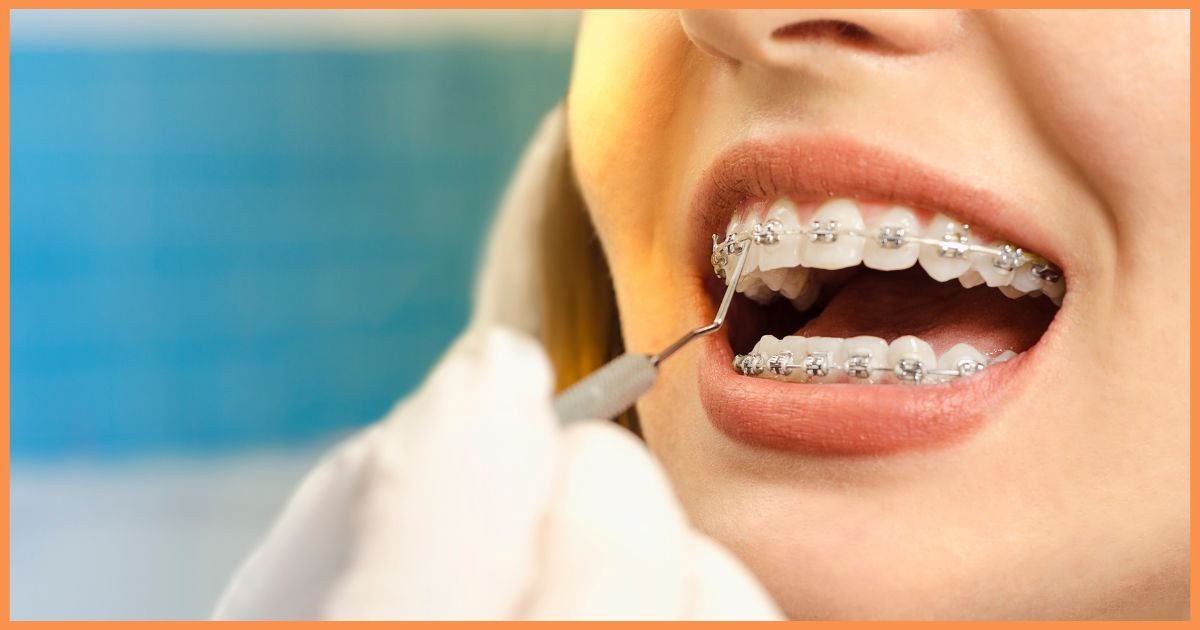Do Braces Make Teeth 100% Straight?