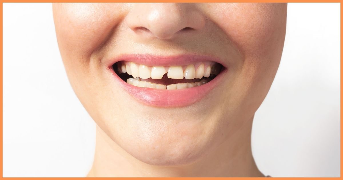 What Is the Best Remedy for a Broken Tooth?