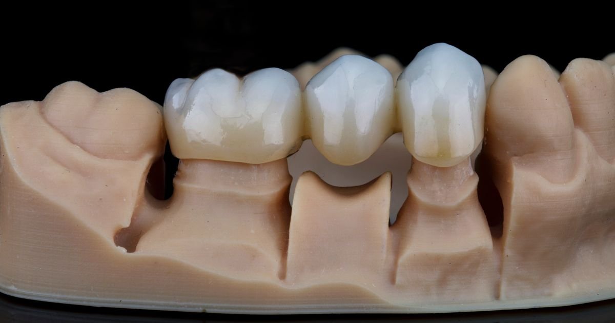 Dental Crown Treatment: How It Works, Benefits, Types & Cost