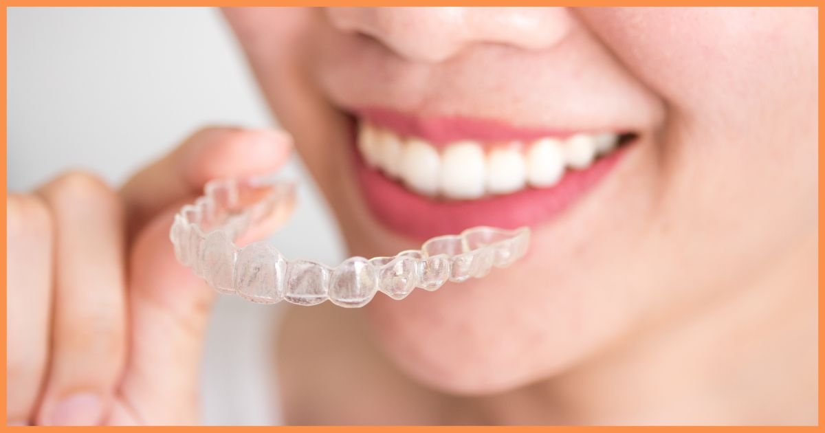 What Is the 30-Minute Rule for Invisalign?