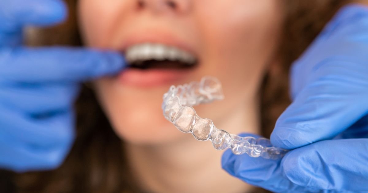 What Is the 30-Minute Rule for Invisalign?