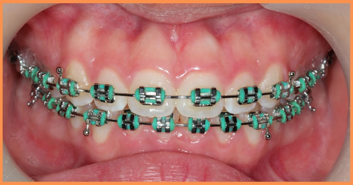 5 Common Myths About Orthodontic Treatment You Shouldn’t Believe