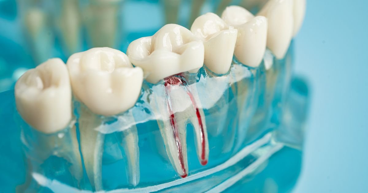 What Is a Better Option Than a Root Canal?
